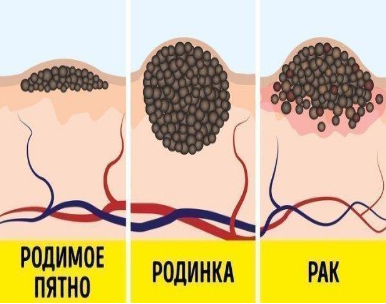 Найнебезпечніші міфи, які можуть спричинити рак
